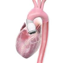 Ascending Aortic Prosthesis Market