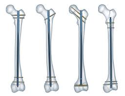 Femoral Intramedullary Nails Market