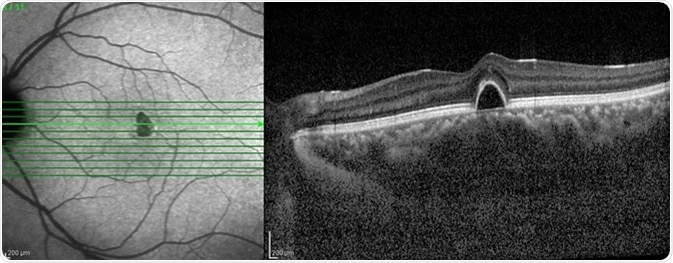 Optical Coherence Tomography market