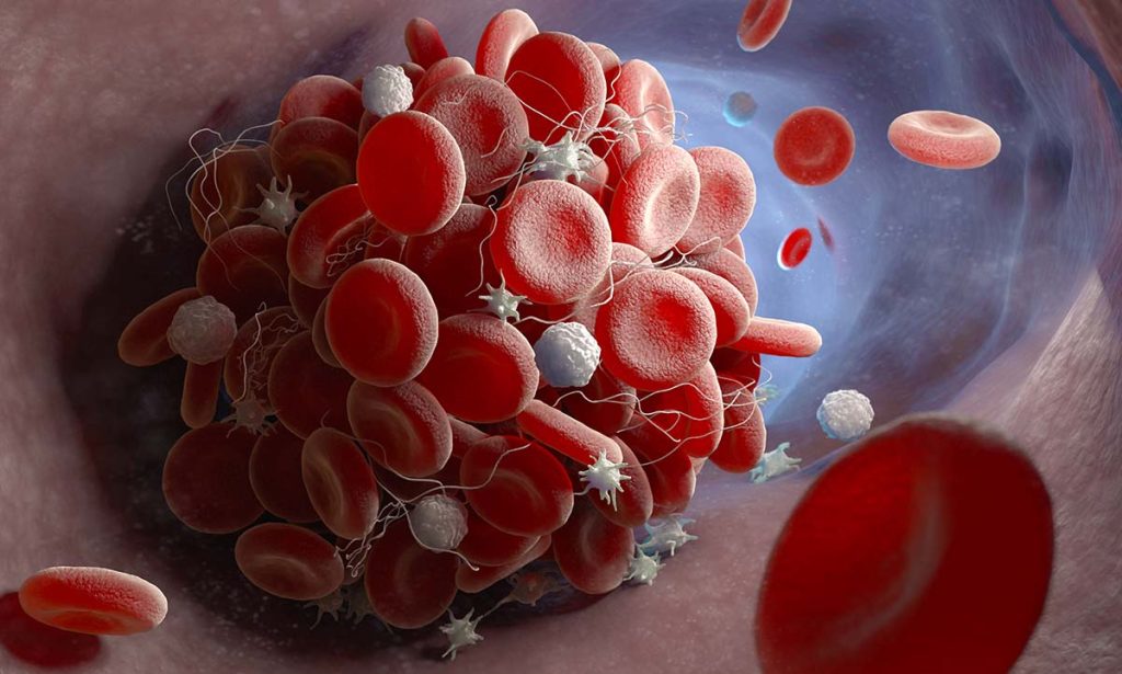 Southeast Asia Lupus anticoagulant Market